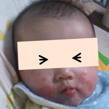 乳児 湿疹 ロコイド プログラム ニュース