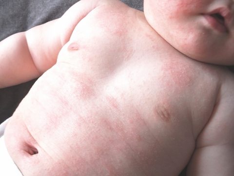 乳児湿疹はどうしてできるの？